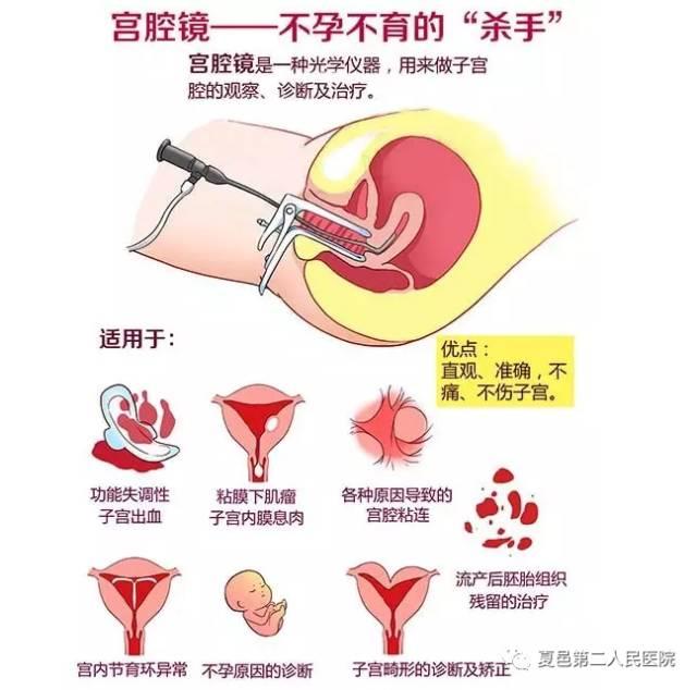 宫腔镜微创检测（妇科微创内窥镜之宫腔镜）(2)