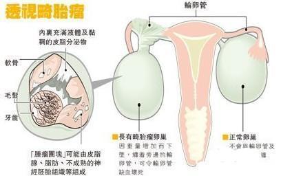 卵巢畸胎瘤是不是很少见（卵巢畸胎瘤是什么）(2)