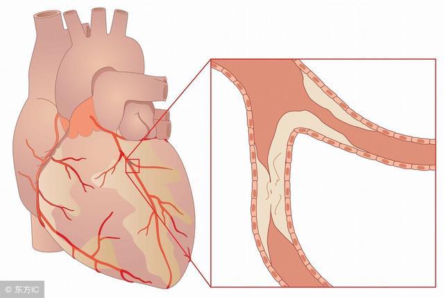 复杂性心脏病有哪些症状（稳定型心脏病怎么理解）