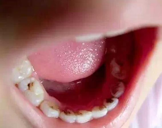 蛀牙补牙后一般能维持多久（睡前疼痛最剧烈）(1)