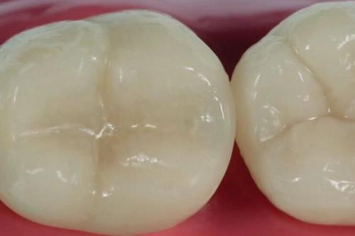 补牙材料好跟差有什么区别（为什么差距那么大）(4)