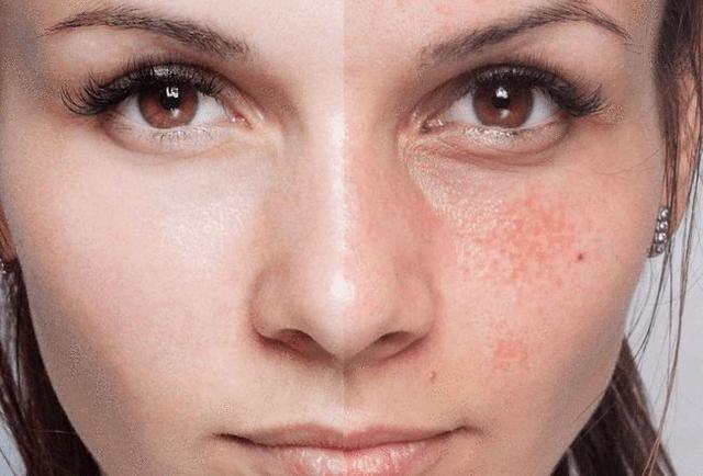 敏感肌肤脸上脱皮是怎么回事（夏季脸上起皮干）(1)