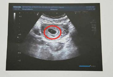 怀孕50天未见胎心和胎芽只见孕囊（怀孕50多天孕囊在长）(8)