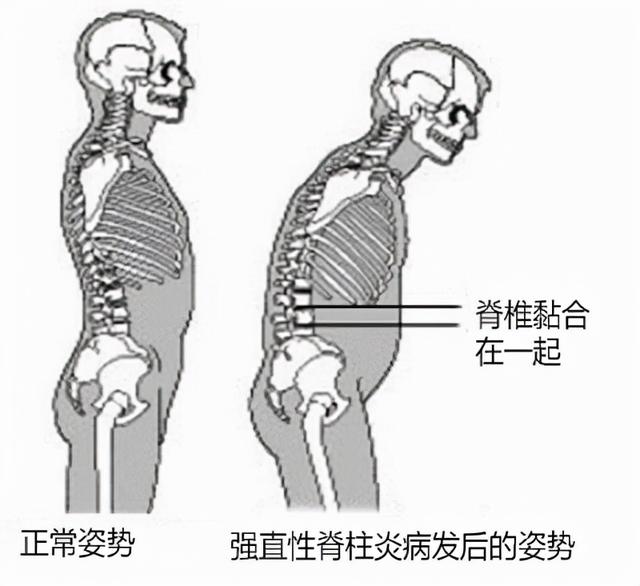 张嘉译的病是强直性脊柱炎吗（张嘉译自曝得了强直性脊柱炎）(3)