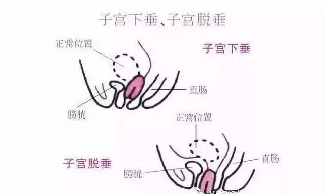 产后膀胱脱垂子宫脱垂怎么恢复（子宫脱垂离我们并不远）(3)