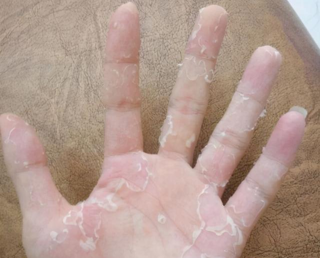 手部皮肤老是脱皮是怎么回事（手部脱皮可能是这四种皮肤病导致的）(3)
