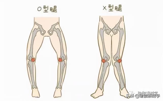 x型腿矫正的瑜伽方法（练瑜伽什么是）(6)