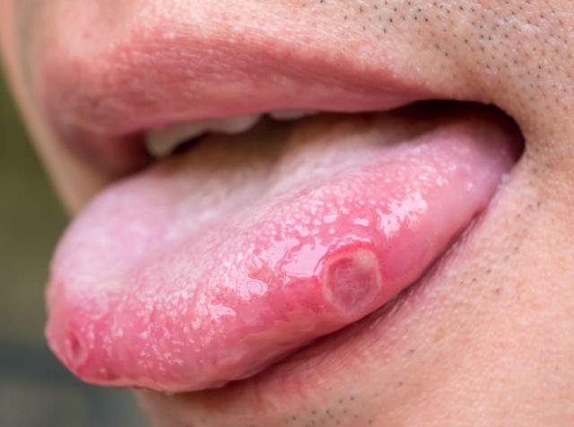 舌癌的溃疡长在什么地方（这些症状以为是溃疡）