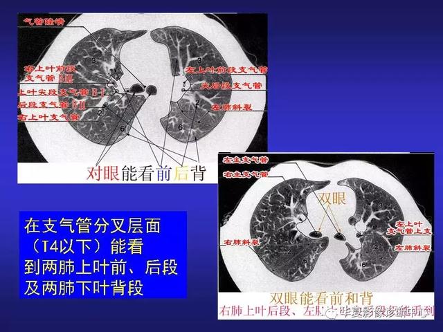 胸部ct检查方法及正常ct解剖（胸部CT解剖及常见病变诊断）(9)