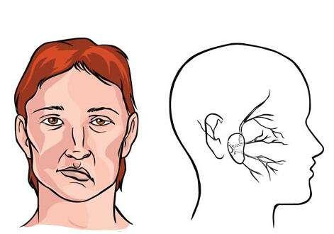 没有嘴歪眼斜的面瘫怎么治（面瘫的各种治疗方法）(1)
