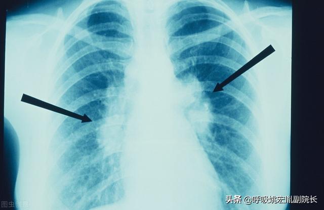 肺病到底有多少种（最常见的有这五种）(5)