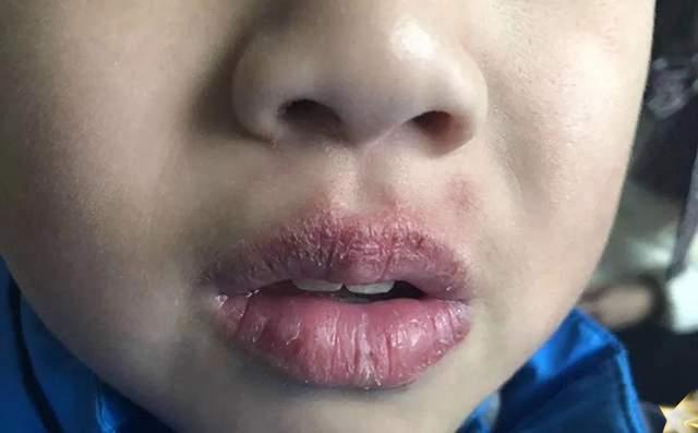儿童嘴唇干裂破皮出血是什么原因（起皮还出血怎么办）