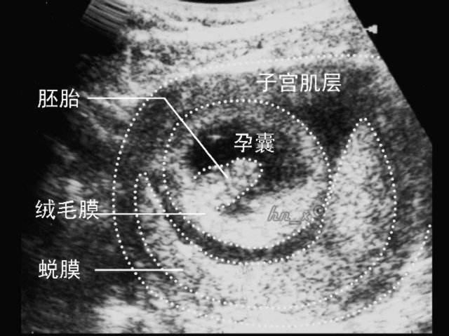怀孕50天未见胎心和胎芽只见孕囊（怀孕50多天孕囊在长）(1)