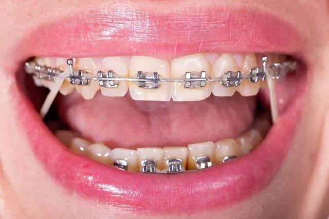关于牙齿矫正最全的科普建议收藏（拒绝选择困难还你完美笑容）(2)