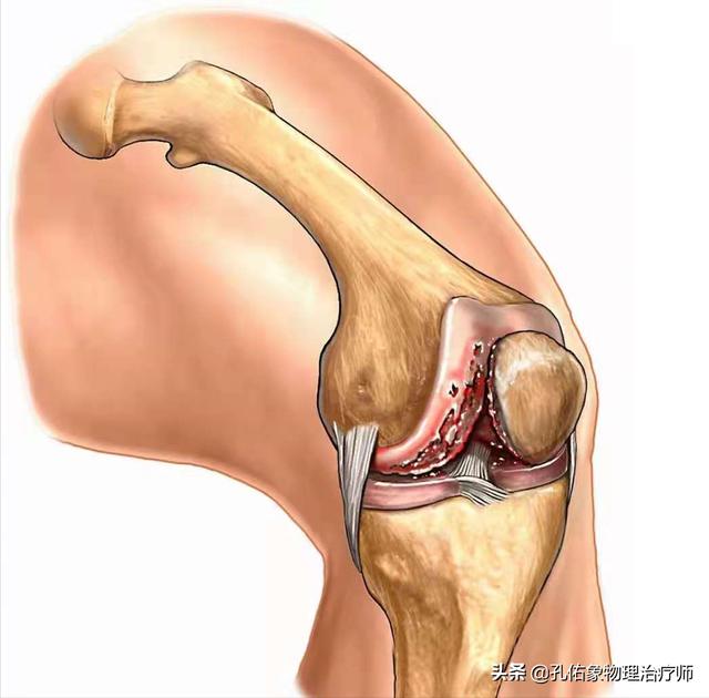 膝关节疼痛可能有三种病（为何发生膝关节疼痛）(8)