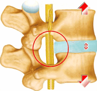椎间盘突出的特征（椎间盘突出的程度及具体辨析）(8)