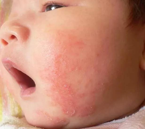 一个多月宝宝过敏性咳嗽怎么办（宝宝咳嗽1月治疗不见好转）(1)