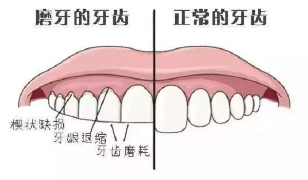 磨牙好久了是什么原因（磨牙是怎么回事）(9)
