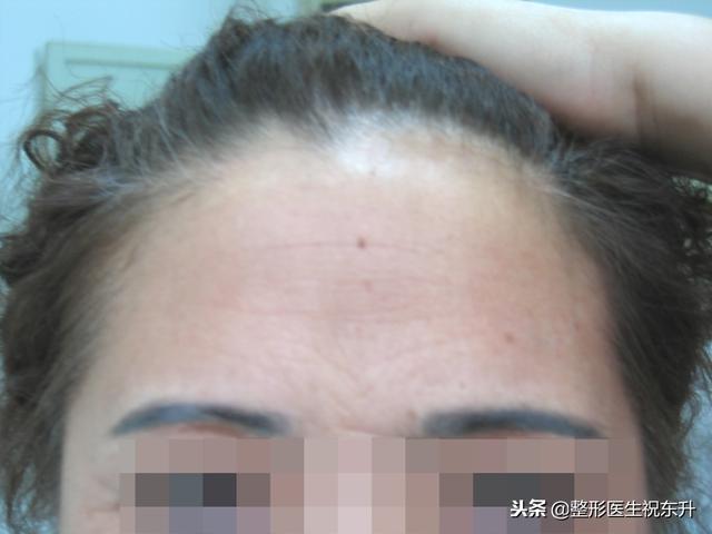 额部除皱去抬头纹的效果怎么样（额颞部拉皮除皱对抗严重抬头纹）(5)