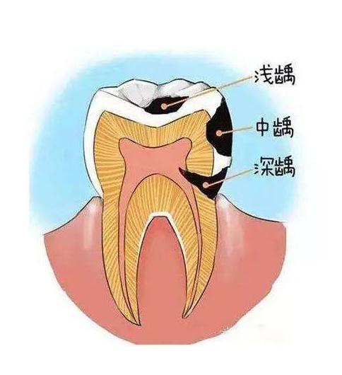 蛀牙补牙后一般能维持多久（睡前疼痛最剧烈）(4)