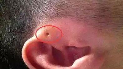 小孩耳朵有一个小洞怎么回事（孩子耳朵有这种小洞要小心）(1)