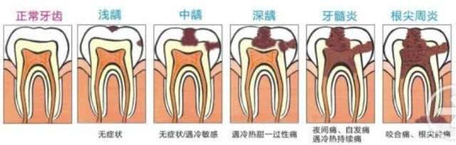 牙神经疼严重吗（牙神经疼怎么办）(3)