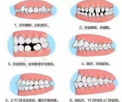多少岁可以进行牙齿矫正（做牙齿矫正最佳年龄是多少岁）(2)