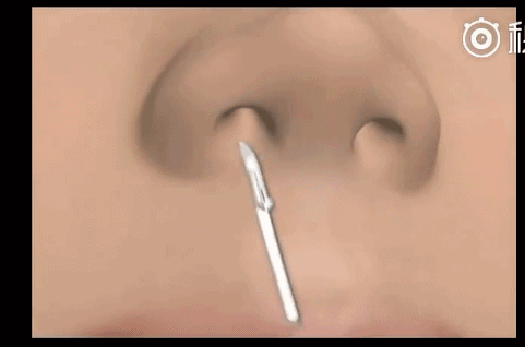 鼻整形要注意什么（如何选择鼻整形方式）(3)