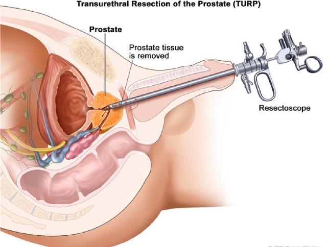 前列腺经尿道电切术后遗症（经尿道前列腺电切术有哪些常见并发症）(2)