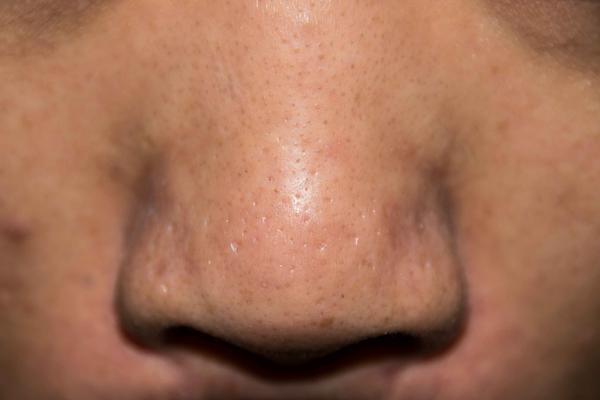 肺有问题在脸上的表现（脸上若出现4种症状）(2)