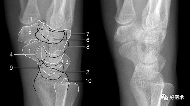 腕关节解剖及损伤的影像诊断（腕关节X线高清解剖）
