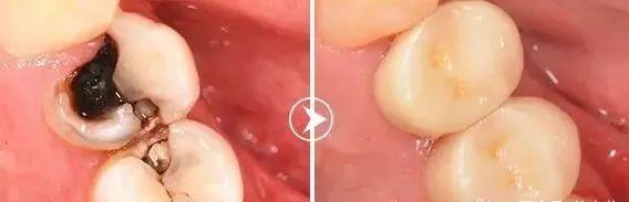 真实补牙过程（揭秘补牙全过程）(10)