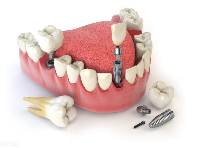 种植牙做了手术后需要注意什么（种植牙痛不痛有没有危害）(1)