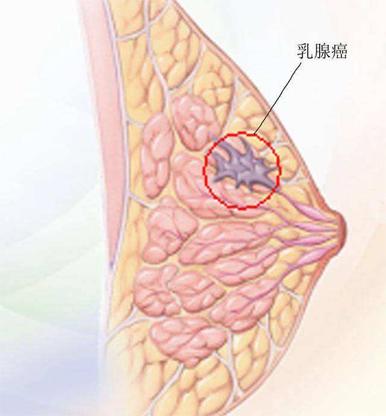 乳腺癌her2突变检测需要做吗 乳腺癌HER2检测结果意味着什么(4)