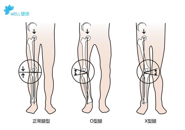 如何改善o型腿和大粗腿（O型腿丑的不止一点点）(1)