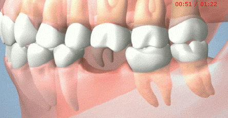 补牙材料好跟差有什么区别（为什么差距那么大）(8)