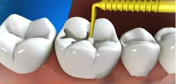 补牙材料好跟差有什么区别（为什么差距那么大）(5)
