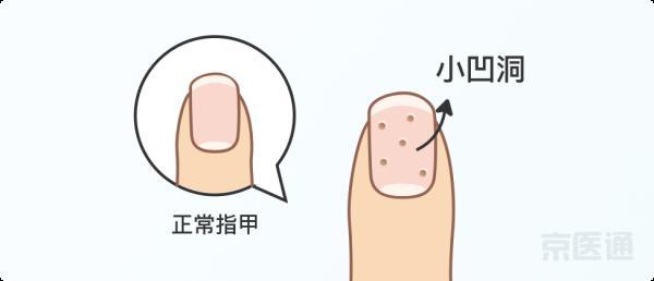 指甲边上长倒刺是什么原因（健康篇指甲上没月牙）(9)