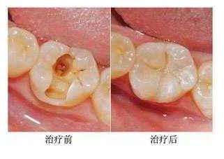 蛀牙补牙后一般能维持多久（睡前疼痛最剧烈）(5)