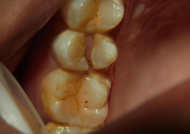 前牙做了根管治疗不需要戴牙冠 根管治疗后没做牙冠(2)