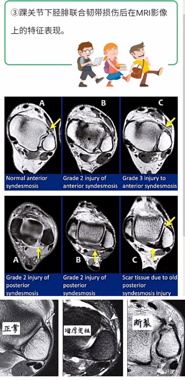 踝关节韧带mri解剖图（踝关节周围韧带的解剖及MRI特征）(13)