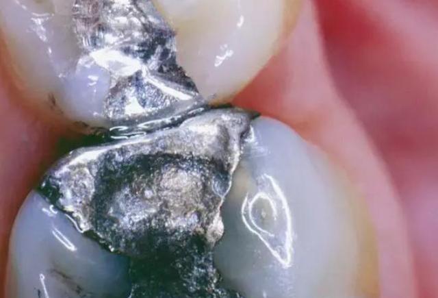 牙齿缺损的补牙过程是怎样的（牙齿缺损后需要补牙）(3)