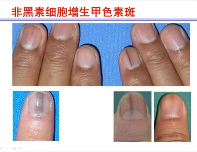 指甲内有细小的黑线是发生了什么（指甲上有条黑线是什么病）(2)