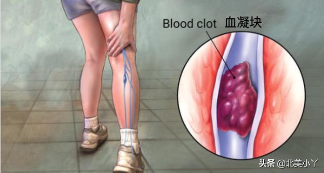 有哪些原因可造成腿疼（注意15种常见病可以引起腿疼）(2)