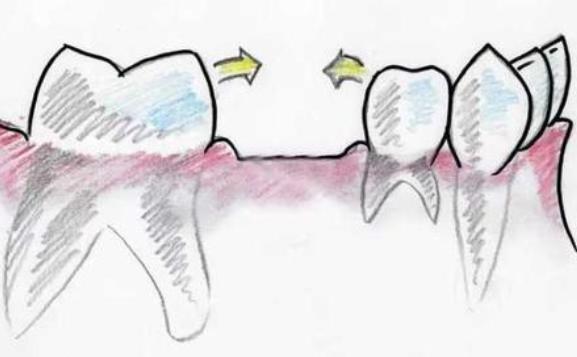 牙缝大了什么原因怎么解决（这几大原因需要注意）(3)