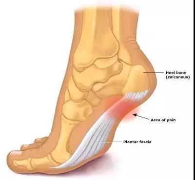 足底筋膜炎有哪些具体表现（什么是足底筋膜炎）(3)