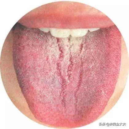 舌头癌症早期症状（舌头有这三个特征）