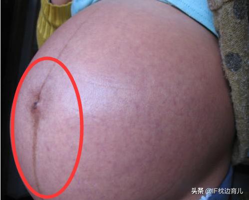 怀孕有不长黑线的吗（怀孕后有黑线就是生男宝）(2)