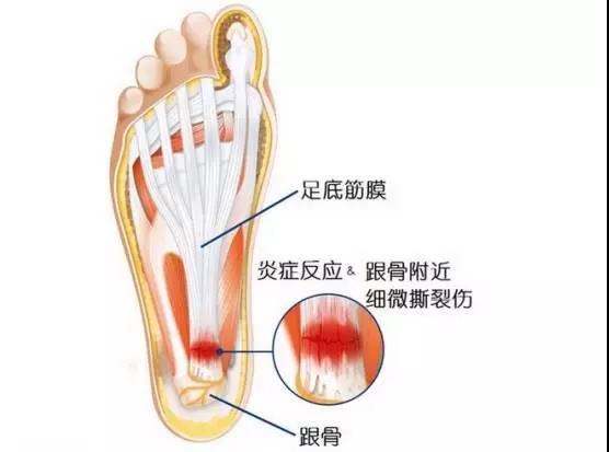 足底筋膜炎有哪些具体表现（什么是足底筋膜炎）