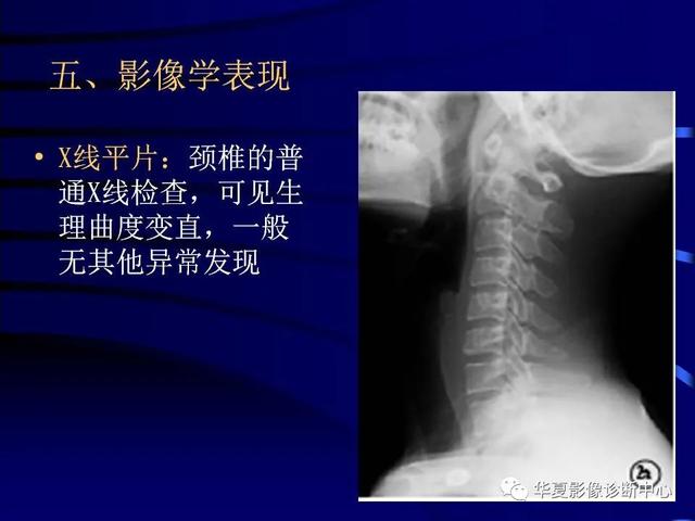 颈椎脊髓病严重了有什么症状（不可忽视的一种颈椎）(14)